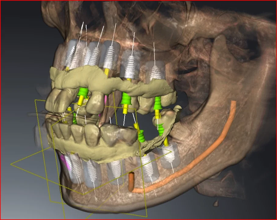 3D CBCT planning for a full-arch All-on-X case at Centre Dental, implants positioned around the traced nerve