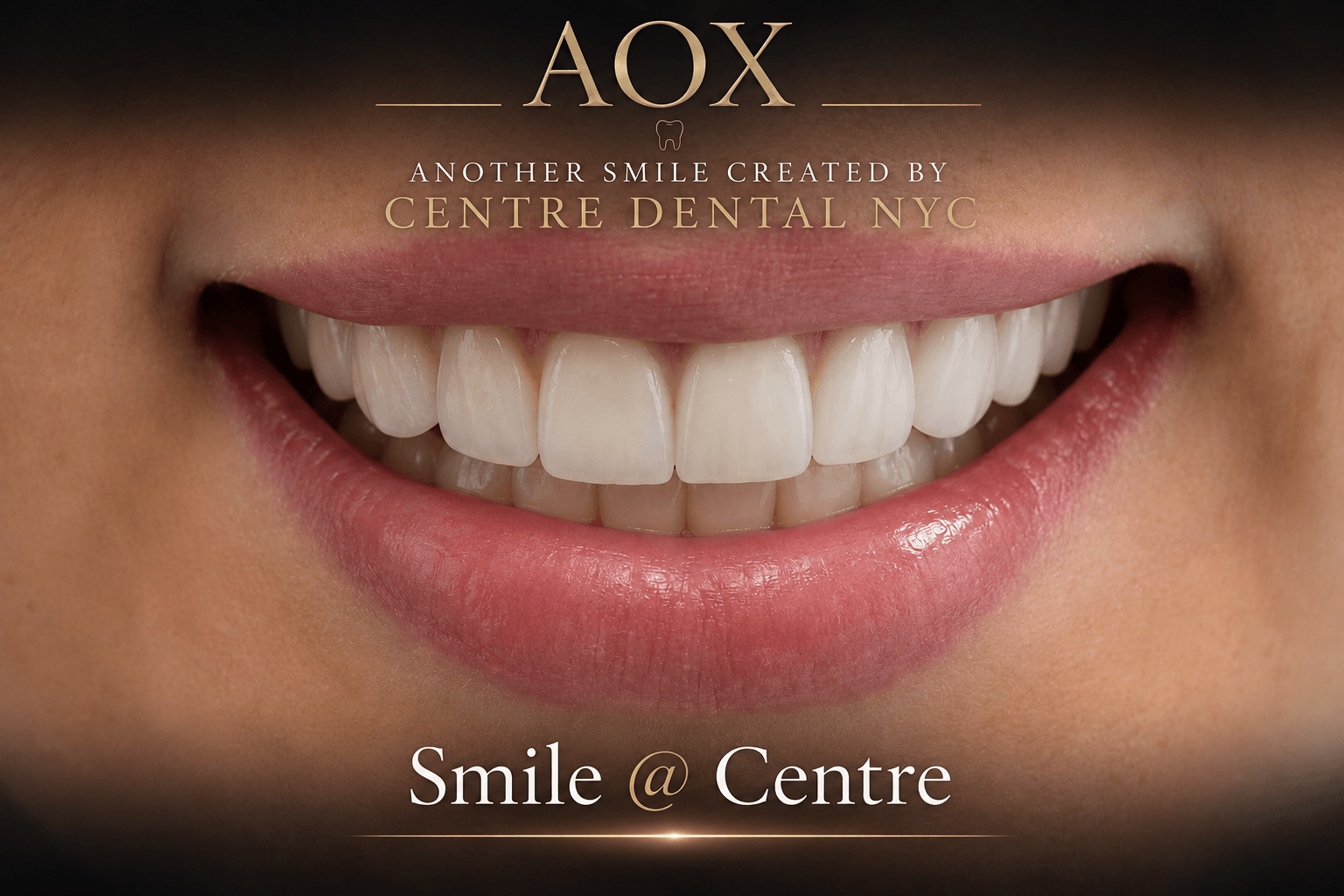 All-on-X full-arch implant model showing implant supports beneath a fixed arch — Centre Dental NYC