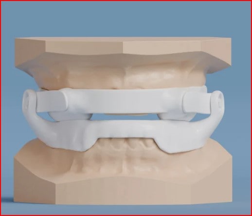 A custom sleep-apnea oral appliance in its case — Centre Dental NYC