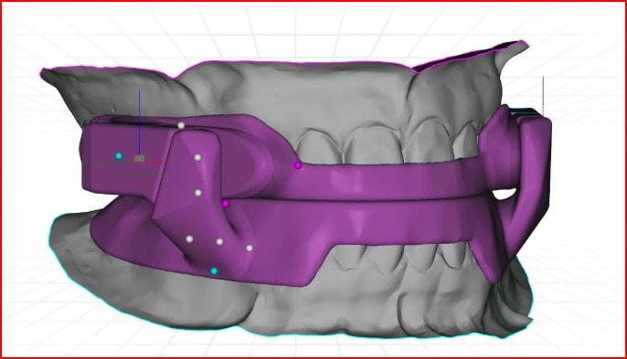 Sleep Apnea Oral Appliance NYC | Snoring Treatment | Centre Dental - Custom-fit oral appliances for snoring and mild-to-moderate obstructive sleep apnea