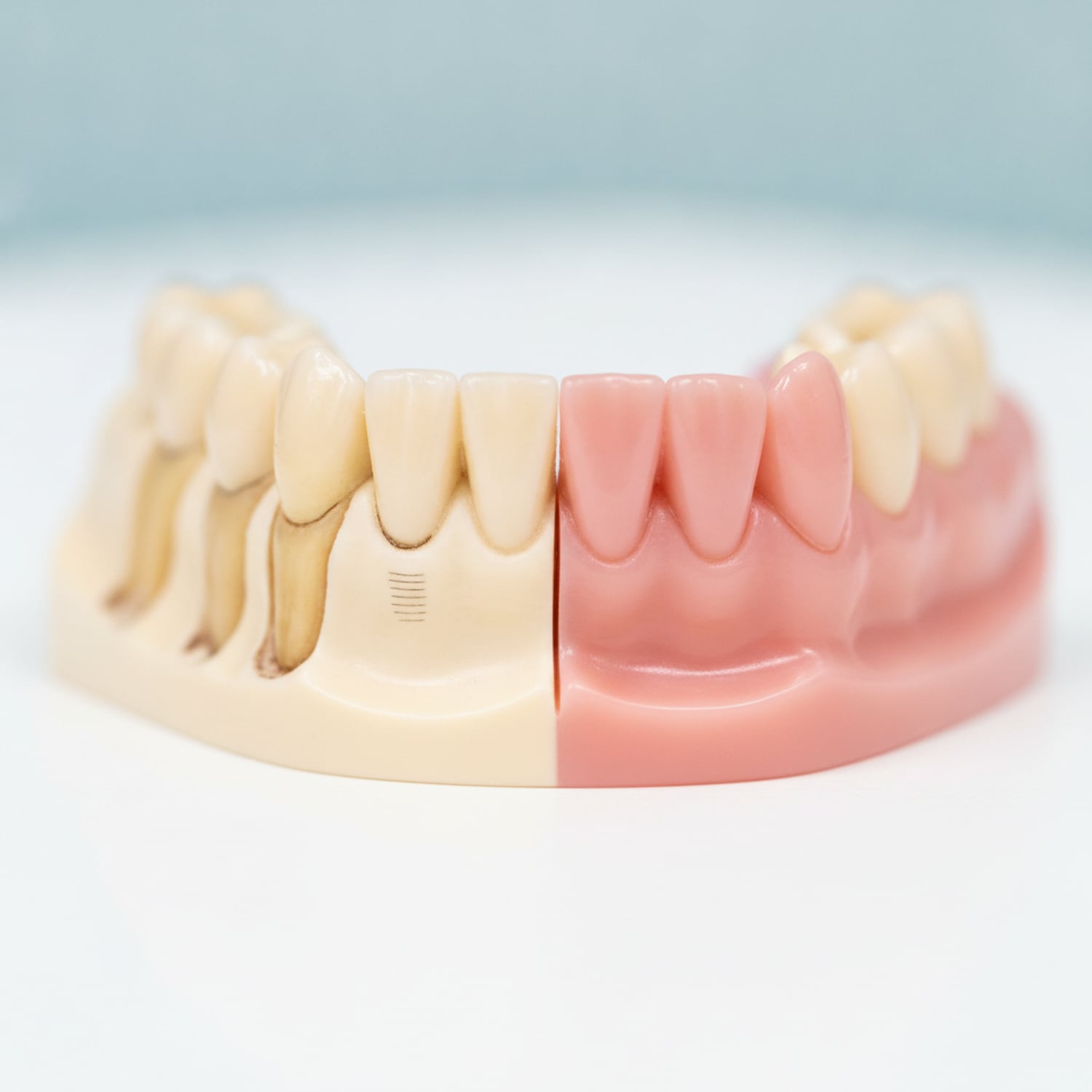 Model comparing receded gums with exposed roots against a fully restored gumline — the goal of Pinhole gum rejuvenation — Centre Dental NYC
