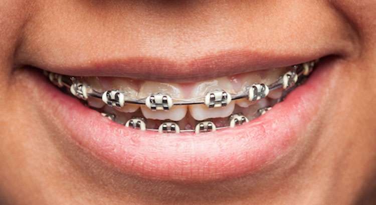 After — implant-supported full-arch restoration, Centre Dental NYC Lower Manhattan