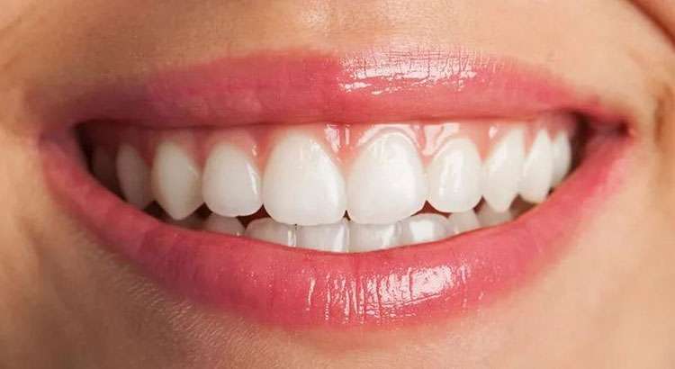 Before — failing upper dentition with advanced periodontal breakdown, candidate for full-arch reconstruction at Centre Dental NYC