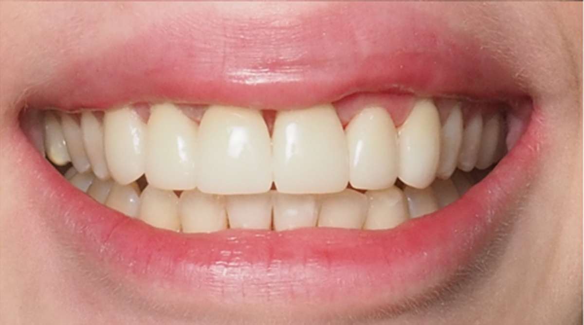 After — natural-looking anterior cosmetic restoration at Centre Dental