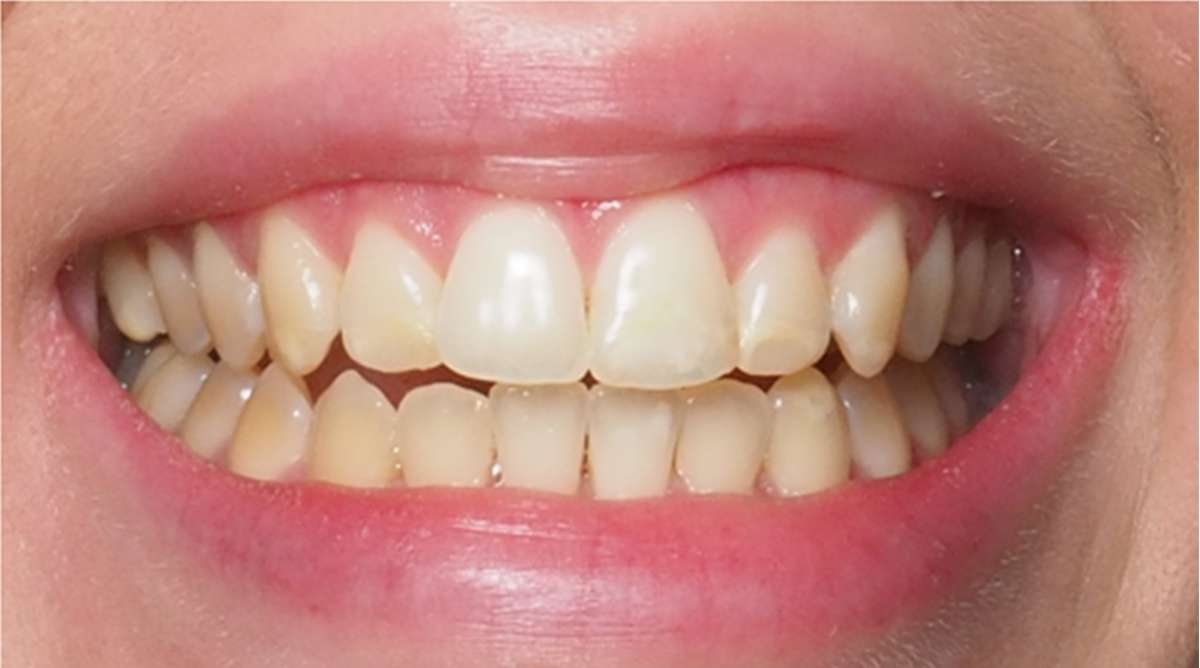 Before — worn and chipped anterior teeth prior to cosmetic restoration