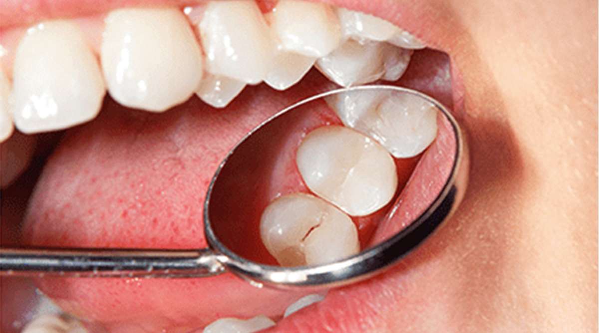 After — zirconia crown on a 3D-guided single implant, Centre Dental NYC