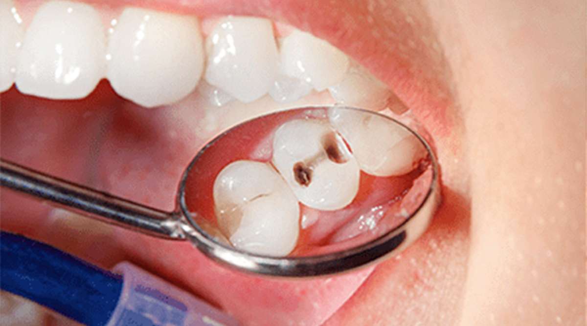 Before — failed posterior tooth prior to single implant placement